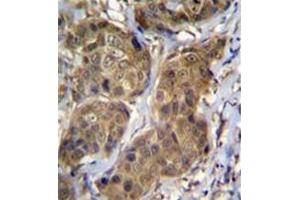 Formalin fixed, paraffin embedded human breast carcinoma stained with RNF11 Antibody (Center) followed by peroxidase conjugation of the secondary antibody and DAB staining (RNF11 anticorps  (Middle Region))