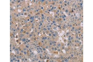 Immunohistochemistry of Human breast cancer using CLIC1 Polyclonal Antibody at dilution of 1:30 (CLIC1 anticorps)