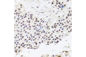 Immunohistochemistry of paraffin-embedded human lung cancer using RPP30 antibody (ABIN5974603) at dilution of 1/100 (40x lens). (RPP30 anticorps)