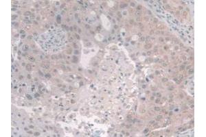 IHC-P analysis of Human Breast Cancer Tissue, with DAB staining. (NCOA3 anticorps  (AA 1023-1304))