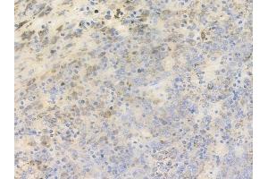 ABIN6256017 and ABIN6267403 at 1/100 staining human melanoma by IHC-P. (Phospholipase C gamma 2 anticorps  (pTyr753))