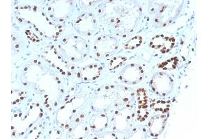 Formalin-fixed, paraffin-embedded human Renal Cell Carcinoma stained with PAX8 Mouse Monoclonal Antibody (PAX8/1492). (PAX8 anticorps  (AA 60-261))