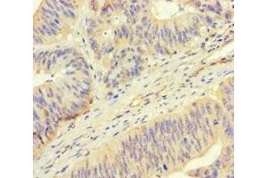 Immunohistochemistry of paraffin-embedded human colon cancer using ABIN7168424 at dilution of 1:100 (ROPN1 anticorps  (AA 1-212))