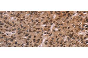 Immunohistochemistry of paraffin-embedded Human liver cancer tissue using LMNB1 Polyclonal Antibody at dilution of 1:60(x200) (Lamin B1 anticorps)