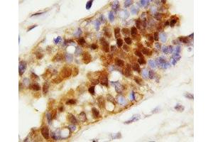 IHC-P: Hsc70 antibody testing of human breast cancer tissue