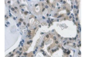 Detection of GAPDH in Human Thyroid cancer Tissue using Monoclonal Antibody to Glyceraldehyde-3-Phosphate Dehydrogenase (GAPDH)