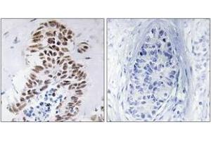 Immunohistochemistry analysis of paraffin-embedded human lung carcinoma tissue, using DAPK3 (Ab-265) Antibody. (DAPK3 anticorps  (AA 241-290))