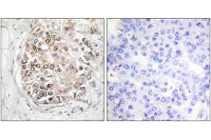 Immunohistochemistry analysis of paraffin-embedded human breast carcinoma, using DNA-PK (Phospho-Ser2056) Antibody.