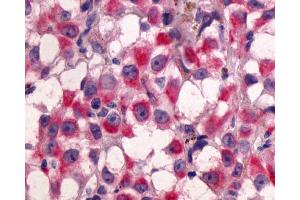 Anti-GPR64 antibody IHC of human Skin, Melanoma. (Adhesion G-Protein Coupled Receptor G2 (ADGRG2) (C-Term) anticorps)