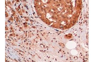 Detection of Ub in Human Breast cancer Tissue using Monoclonal Antibody to Ubiquitin (Ub)