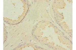 Immunohistochemistry of paraffin-embedded human prostate cancer using ABIN7174924 at dilution of 1:100 (CXorf21 anticorps  (AA 1-301))
