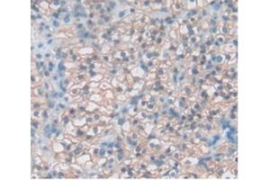 Detection of TIGIT in Human Kidney Cancer Tissue using Polyclonal Antibody to T-Cell Immunoreceptor With Ig And ITIM Domains Protein (TIGIT)