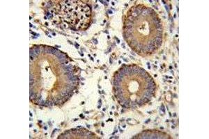 CEA antibody immunohistochemistry analysis in formalin fixed and paraffin embedded human colon carcinoma. (CEA anticorps  (AA 400-429))