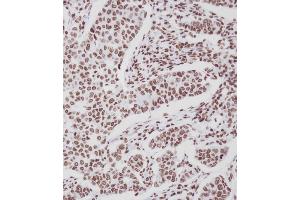 Immunohistochemical analysis of A on paraffin-embedded Human breast carcinoma tissue.