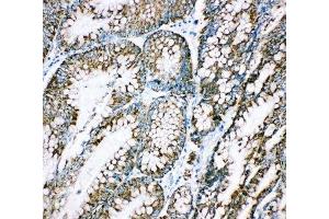 IHC-P: HSP10 antibody testing of human intestinal cancer tissue (HSPE1 anticorps  (C-Term))