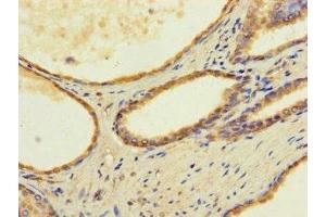 Immunohistochemistry of paraffin-embedded human prostate cancer using ABIN7173179 at dilution of 1:100 (TMEM255B anticorps  (AA 221-356))
