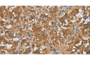 Immunohistochemistry of paraffin-embedded Human thyroid cancer tissue using FOXB1 Polyclonal Antibody at dilution 1:30 (FOXB1 anticorps)