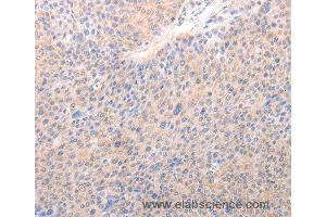 Immunohistochemistry of Human lung cancer using ACO1 Polyclonal Antibody at dilution of 1:50 (Aconitase 1 anticorps)