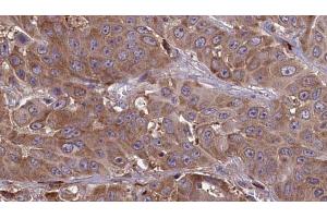 ABIN6273643 at 1/100 staining Human liver cancer tissue by IHC-P. (IFITM1 anticorps  (N-Term))