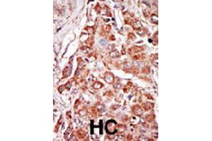 Formalin-fixed and paraffin-embedded human hepatocellular carcinoma tissue reacted with EIF2AK2 polyclonal antibody  , which was peroxidase-conjugated to the secondary antibody, followed by DAB staining. (EIF2AK2 anticorps  (N-Term))