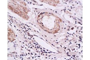 Formalin-fixed and paraffin embedded human gastric carcinoma tissue labeled with Anti-E-Selectin Polyclonal Antibody, Unconjugated at 1:200 followed by conjugation to the secondary antibody and DAB staining