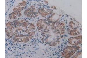 IHC-P analysis of Human Lung Cancer Tissue, with DAB staining. (AKT2 anticorps  (AA 142-412))