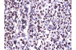 Formalin-fixed and paraffin embedded human breast carcinoma labeled with Anti-CDK6 Polyclonal Antibody (ABIN670236), Unconjugated at 1:200, followed by conjugation to the secondary antibody and DAB staining (CDK6 anticorps  (AA 21-110))