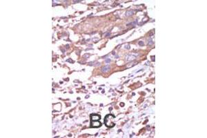Formalin-fixed and paraffin-embedded human cancer tissue reacted with CAMK2A polyclonal antibody  , which was peroxidase-conjugated to the secondary antibody, followed by AEC staining. (CAMK2A anticorps  (C-Term))