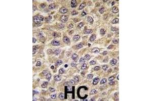 Formalin-fixed and paraffin-embedded human hepatocarcinoma tissue reacted with ILK Antibody  (ABIN391996 and ABIN2841782) , which was peroxidase-conjugated to the secondary antibody, followed by DAB staining.