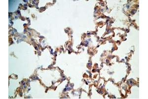 Rat lung cancer tissue stained by Rabbit Anti-CRAMP (Mouse) Antibody (Cathelicidin anticorps  (AA 140-173))