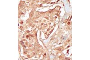 Formalin-fixed and paraffin-embedded human cancer tissue reacted with the primary antibody, which was peroxidase-conjugated to the secondary antibody, followed by DAB staining. (CDK18 anticorps  (N-Term))