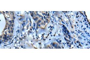 Immunohistochemistry of paraffin-embedded Human cervical cancer tissue using UFC1 Polyclonal Antibody at dilution of 1:50(x200) (UFC1 anticorps)