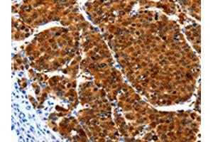 The image on the left is immunohistochemistry of paraffin-embedded Human liver cancer tissue using ABIN7190937(HIBADH Antibody) at dilution 1/25, on the right is treated with synthetic peptide. (HIBADH anticorps)
