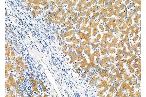 ABIN6264168 and ABIN6277664 at 1/100 staining Human liver cancer and adjacent normal tissues by IHC-P.