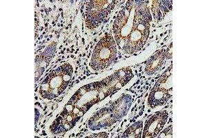 Immunohistochemical analysis of TERE1 staining in human colon cancer formalin fixed paraffin embedded tissue section. (UBIAD1 anticorps)