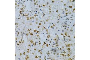 Immunohistochemistry of paraffin-embedded human kidney cancer using ELAVL1 Antibody (ABIN5970780) at dilution of 1/200 (40x lens). (ELAVL1 anticorps)