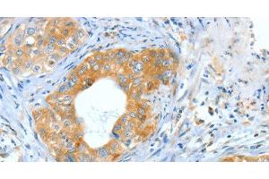 Immunohistochemistry of paraffin-embedded Human cervical cancer using ASNS Polyclonal Antibody at dilution of 1:60