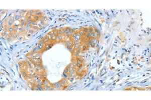 Immunohistochemistry of paraffin-embedded Human cervical cancer using ASNS Polyclonal Antibody at dilution of 1:60 (Asparagine Synthetase anticorps)