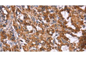 Immunohistochemistry of paraffin-embedded Human thyroid cancer tissue using HACE1 Polyclonal Antibody at dilution 1:40 (HACE1 anticorps)
