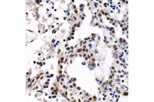 Immunohistochemistry of paraffin-embedded human lung cancer using ID3 antibody (ABIN6130481, ABIN6142140, ABIN6142141 and ABIN6221020) at dilution of 1:200 (40x lens). (ID3 anticorps  (AA 1-119))
