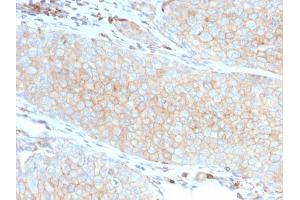 Formalin-fixed, paraffin-embedded human Basal Cell Carcinoma stained with PD-L1-Monospecific Mouse Monoclonal Antibody (PDL1/2746).
