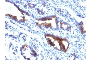 Formalin-fixed, paraffin-embedded human Gastric Carcinoma stained with MUC3 Mouse Monoclonal Antibody (M3. (MUC3A anticorps)
