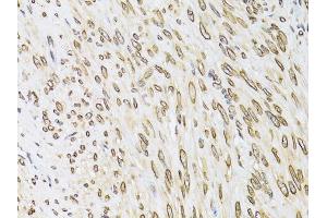 Immunohistochemistry of paraffin-embedded human uterine cancer using EMD antibody. (Emerin anticorps)