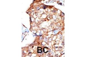 Formalin-fixed and paraffin-embedded human cancer tissue reacted with the primary antibody, which was peroxidase-conjugated to the secondary antibody, followed by DAB staining.