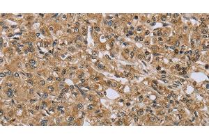 Immunohistochemistry of paraffin-embedded Human prostate cancer using TXLNA Polyclonal Antibody at dilution of 1:30 (alpha Taxilin anticorps)