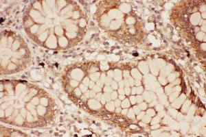 Anti-ALOX15 Picoband antibody,  IHC(P): Human Intestine Cancer Tissue