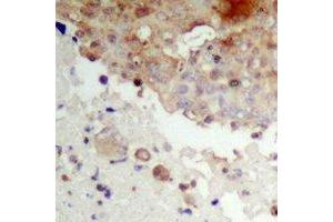 Immunohistochemical analysis of IKB epsilon (pS22) staining in human prostate cancer formalin fixed paraffin embedded tissue section. (NFKBIE anticorps  (pSer22))