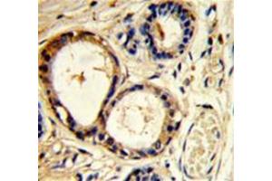 Immunohistochemistry analysis of human breast carcinoma (Formalin-fixed, Paraffin-embedded) using Cortactin (SRC8)  Antibody  (N-term), followed by  peroxidase-conjugated secondary antibody and DAB staining. (Cortactin anticorps  (N-Term))