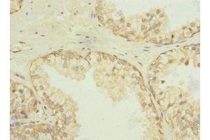 Immunohistochemistry of paraffin-embedded human prostate cancer using ABIN7170943 at dilution of 1:100 (Sulfide:quinone Oxidoreductase, Mitochondrial (SQOR) (AA 211-450) anticorps)