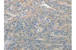 The image on the left is immunohistochemistry of paraffin-embedded Human ovarian cancer tissue using ABIN7131158(SPATA17 Antibody) at dilution 1/15, on the right is treated with fusion protein. (SPATA17 anticorps)